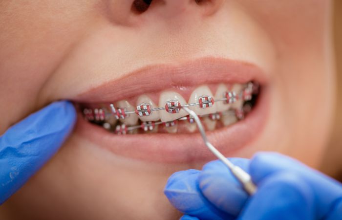 Orthodontic Treatment
