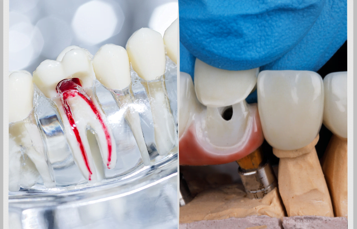 Root Canal & Dental Crowns: Why They Go Hand in Hand | Diagnopein